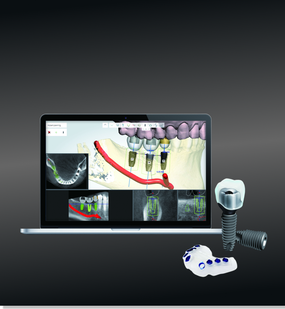 Digital Implant